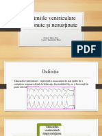 Aritmiile Ventriculare Susținute Și Nesusținute