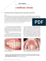 Barra palatina modificada intrusão de molares