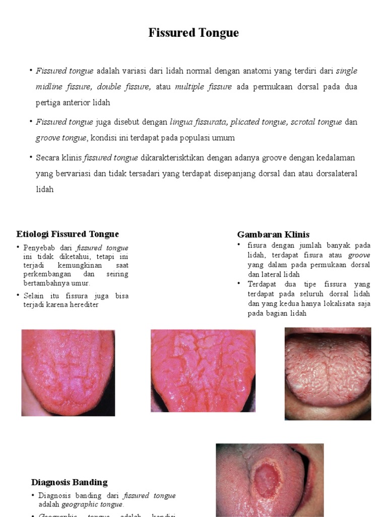 Fissured Tongue PDF