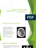 CT SCAN MENGGAMBARKAN PERDARAHAN INTRAKRANIAL