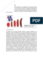 Anemia Falciforme