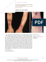 Painful Nodules On The Arms: Images in Clinical Medicine