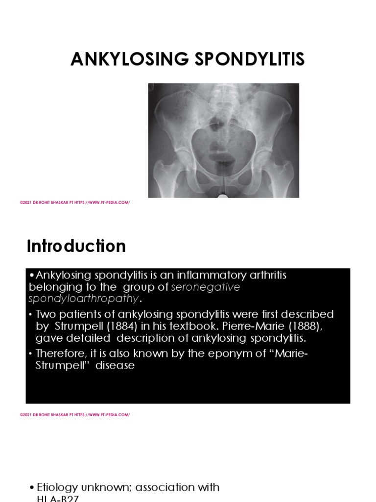 Ankylosing Spondylitis - DR Rohit Bhaskar | PDF | Vertebral Column ...