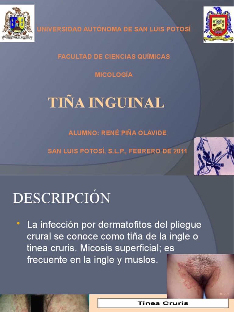 Tiña Inguinal Tratamiento : Hongo en la ingle: síntomas, causas y ...
