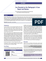 A Mystical Practice Revealed On The Radiograph: A Case Report and Review