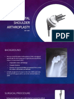 Reverse Total Shoulder Arthroplasty - King