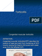 Torticollis