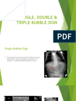 Single, Double & Triple Bubble Sign