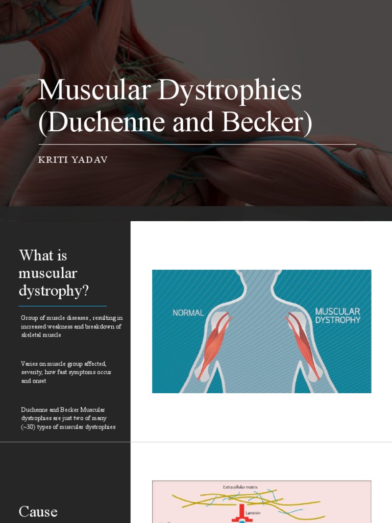 Muscular Dystrophies (Duchenne and Becker) PDF Muscular Dystrophy