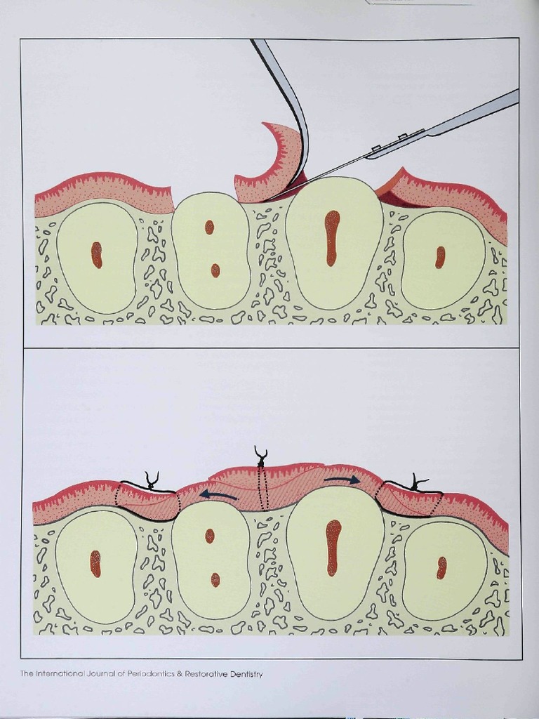 Tile Internationai Journal of Periadantics & Restorative Dentistry ...