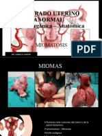 miomatosis uterina
