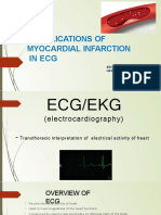 Complications of Myocardial Infarction in ECG