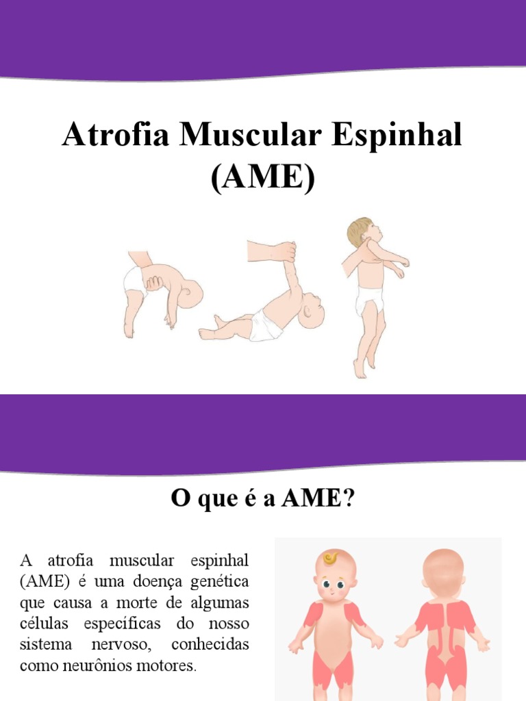 Entendendo a Atrofia Muscular Espinhal | PDF | Neurônio motor | Músculo
