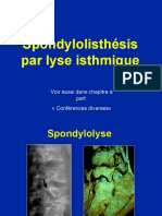 6- Spondylolisthésis