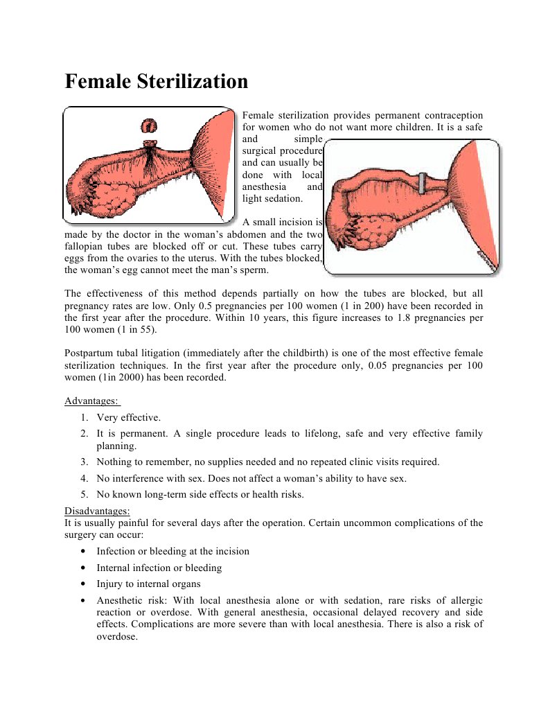 Female Sterilization PDF Human Reproduction Fertility