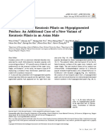 Unilateral Linear Keratosis Pilaris On Hypopigment