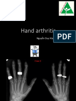 Hand Arthritis Approching