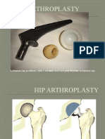 Hip Arthroplasty: A Titanium Hip Prosthesis, With A Ceramic Head and Polyethylene Acetabular Cup