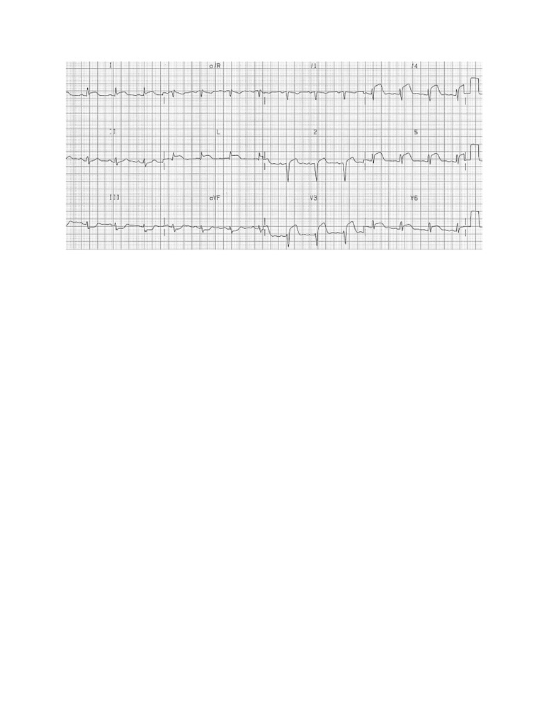 Gambar Ekg | PDF