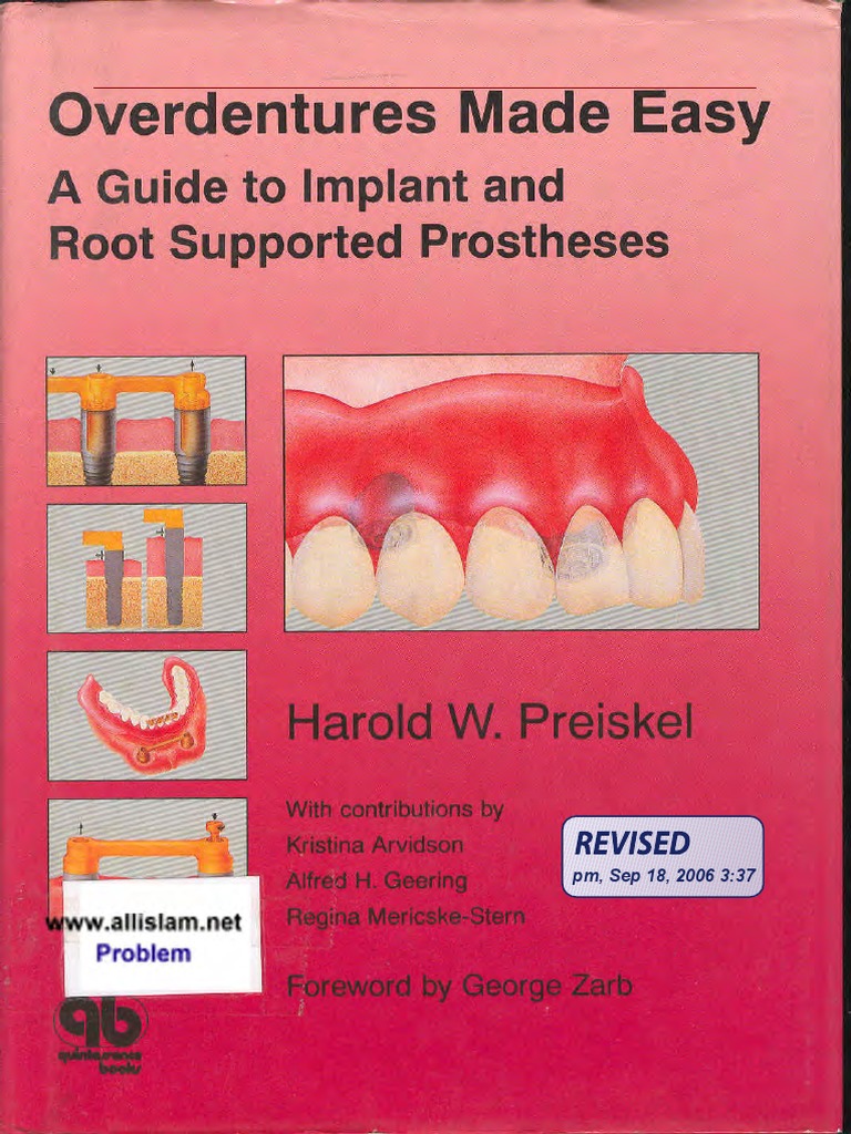 Overdentures Made Easy: A Guide to Implant and Root