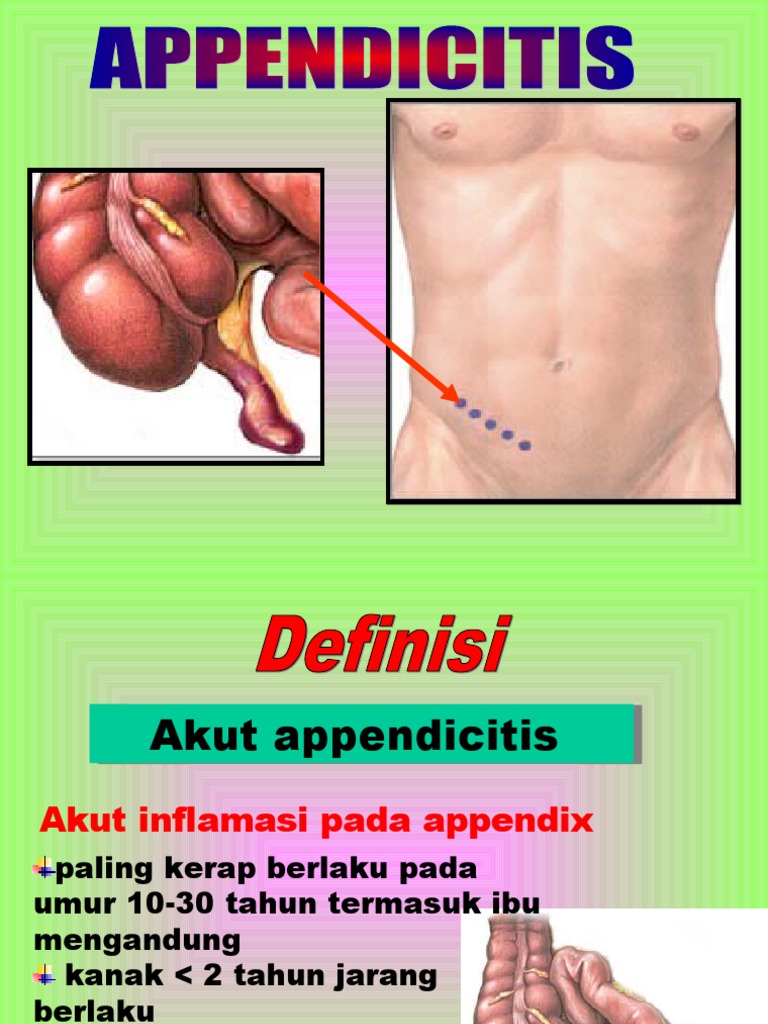 17.acute Appendicitis | PDF