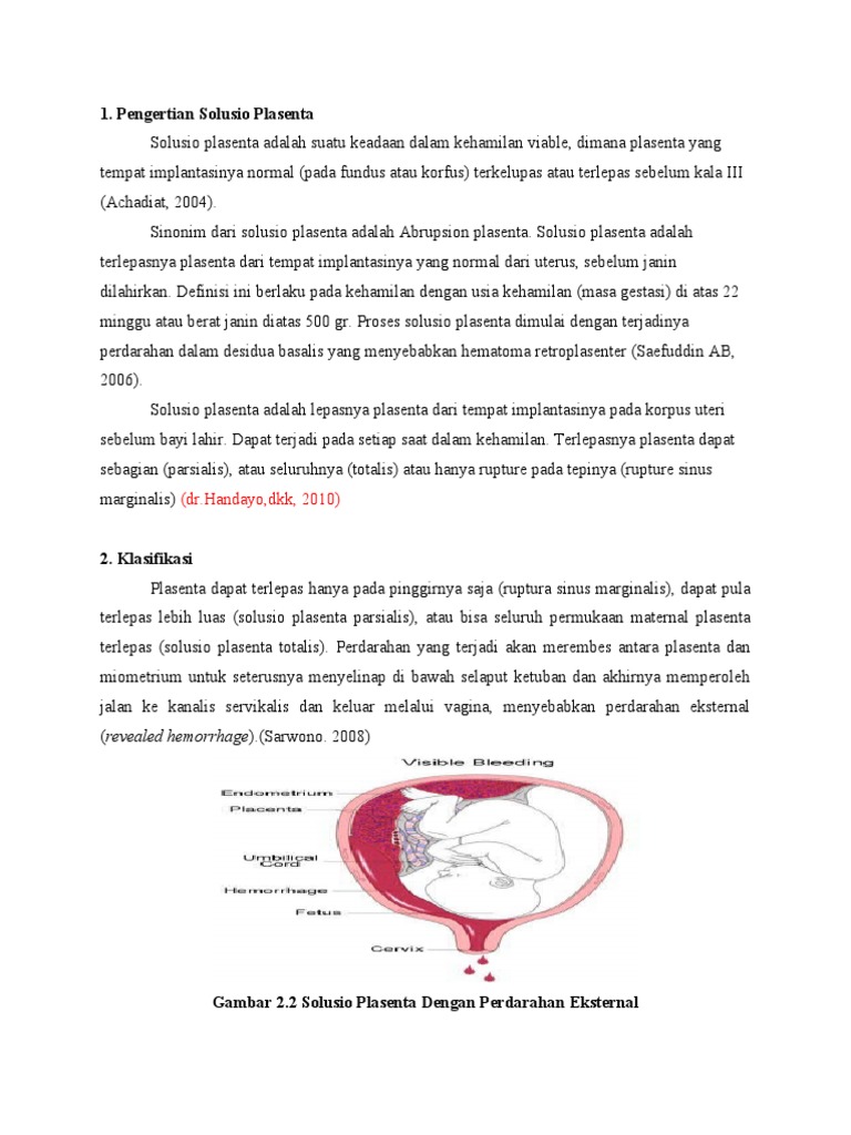 Pengertian dan Klasifikasi Solusio Plasenta | PDF