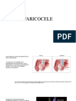 VARICOCELE