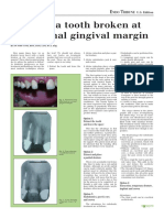 Treating a tooth broken at cervical margin