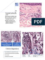 Vasculitis Leucocitoclástica