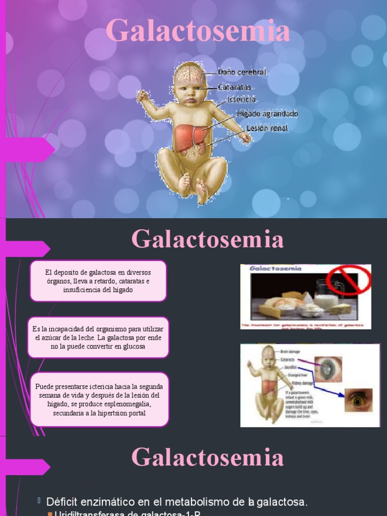 Síntomas y tipos de galactosemia | PDF