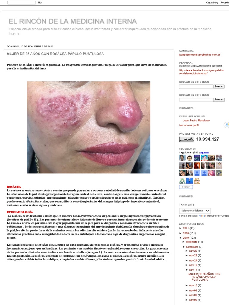 Rosácea Pápulo Pustulosa en Mujer de 36 Años | PDF | Especialidades ...