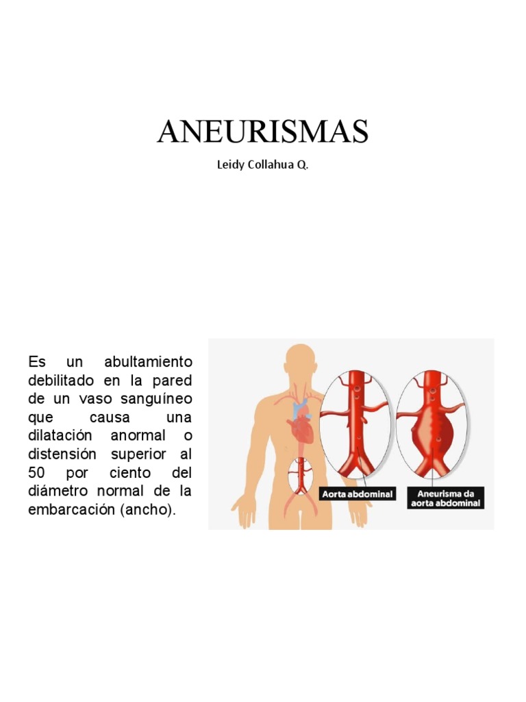 Aneurism As | PDF