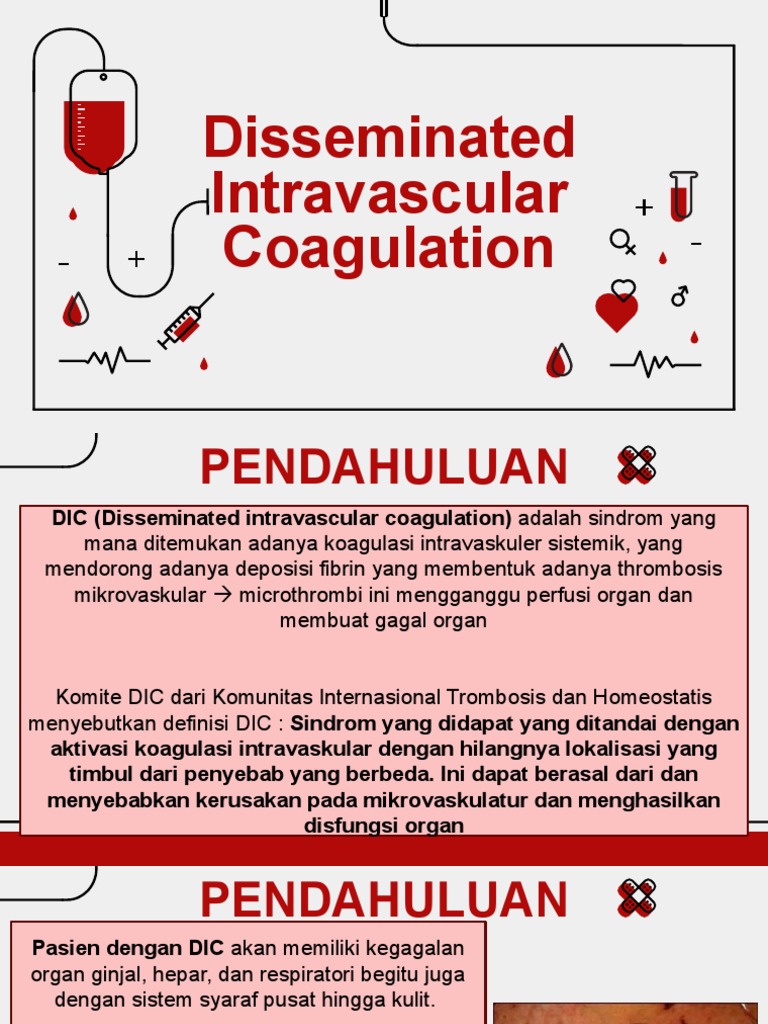 Disseminated Intravascular Coagulation | PDF