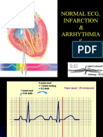 Normal Ecg, Infarction & Arrhythmia S