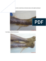 Actinomycosis