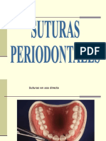 -suturas-en-Periodoncia