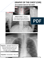 Plain Radiography of The Chest (CXR)