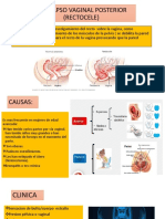 Prolapso Vaginal Posterior