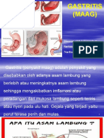 Gastritis (Maag)