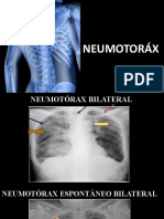 NEUMOTORAX