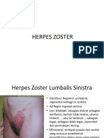 Herpes Zoster Kasus