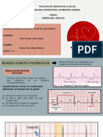 Bloqueos Auriculoventriculares