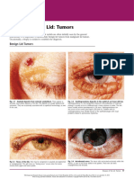 Diseases of The Lid Tumors