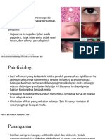 Chalazion