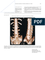 Bamboo Spine in A Patient With Ankylosing Spondylitis
