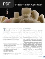 Model Guided Soft Tissue Augmentation