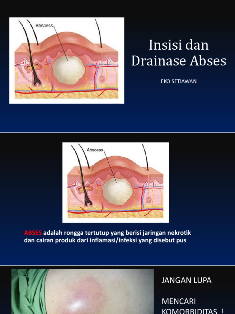 Insisi Dan Drainase Abses | PDF