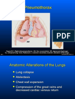 Isa-pnemothorax