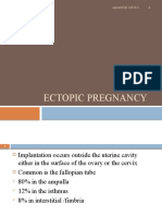 Ectopic Pregnancy