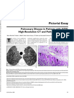 Pulmonary Findings in HIV On CT